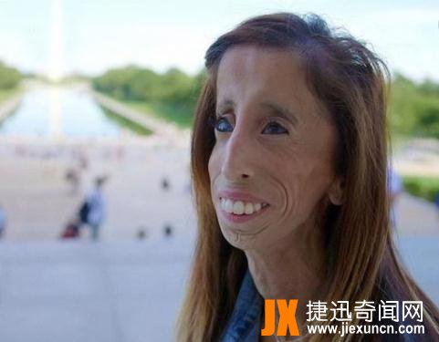 世界上最瘦的人:丽兹-维拉斯奎兹