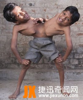 印度连体兄弟被奉“神灵” 不愿分离
