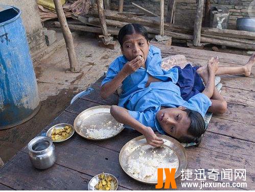 印度连体兄弟