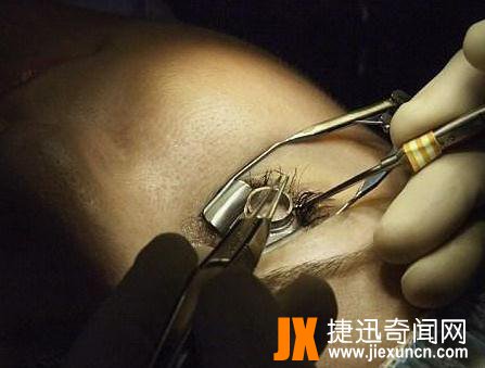 美国美女整容,竟切开眼球往里放金属装饰
