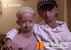 早衰症（儿童早老症）患如此罕见的疾病