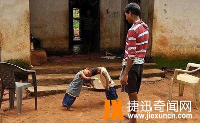 印度连体兄弟,共用一个头颅骨