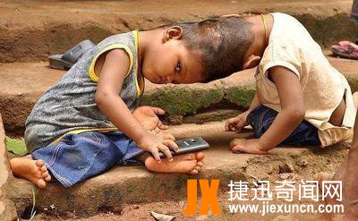 印度连体兄弟,共用一个头颅骨