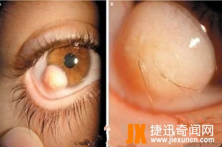 世界十大恐怖眼球，双瞳孔眼乃绝世罕见 胆小慎入