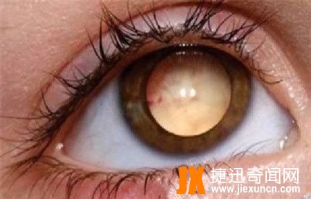 世界十大恐怖眼球，双瞳孔眼乃绝世罕见 胆小慎入