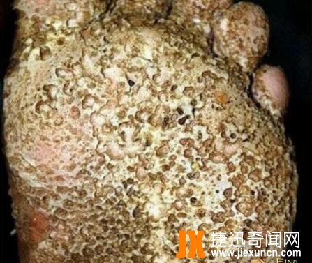 十宗罪玉米男孩真实事件，密集恐惧症人群慎入(图片)