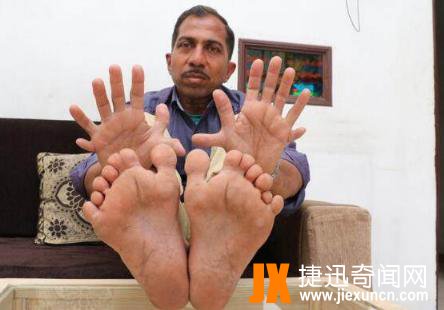 世界上手指脚趾最多的人