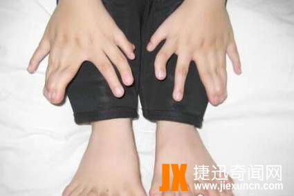 世界上手指脚趾最多的人