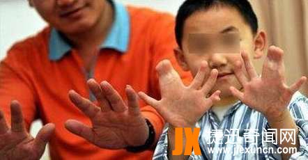 世界上手指脚趾最多的人