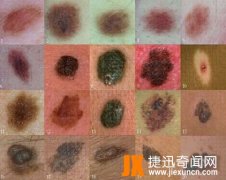 皮肤癌早期症状的一般表现介绍,皮肤癌早期症状图片