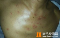 超高清蜘蛛痣图片：一个肝硬化病人前胸蜘蛛痣图片