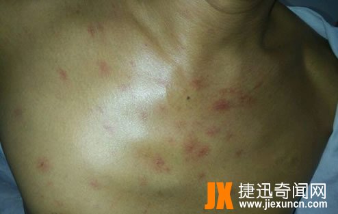 超高清蜘蛛痣图片：一个肝硬化病人前胸蜘蛛痣图片