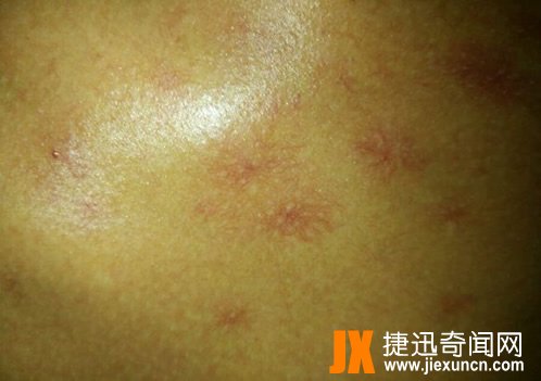 超高清蜘蛛痣图片：一个肝硬化病人前胸蜘蛛痣图片