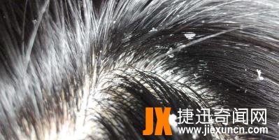 头皮屑多什么什么原因
