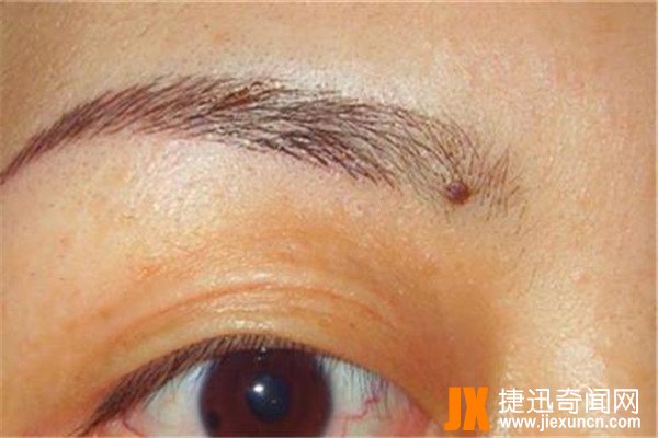 面部10处恶痣:痣在不同位置有不同意义