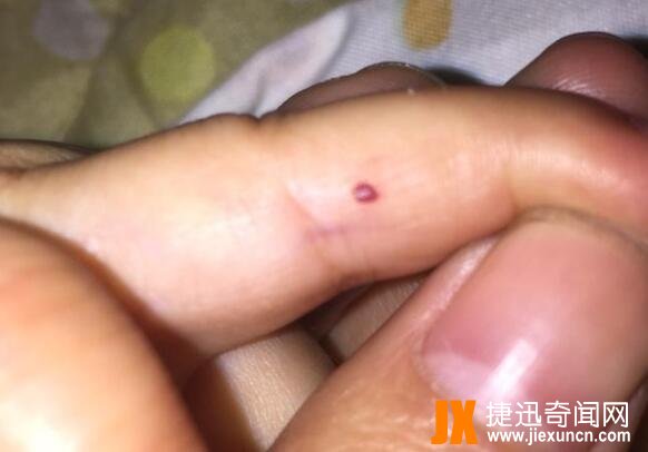 血痣出现10个危害大