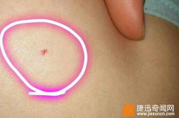 血痣出现10个危害大