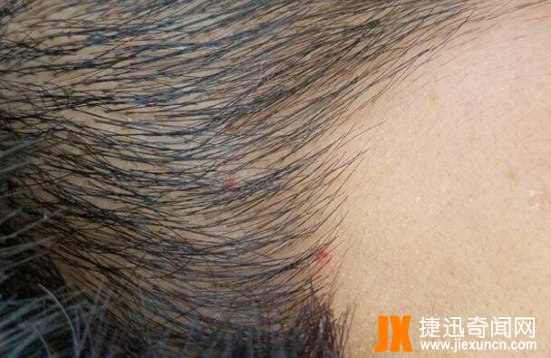 血痣出现10个危害大