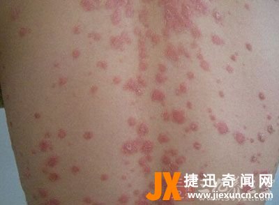 女性红斑狼疮早期症状：红斑狼疮最初症状图片