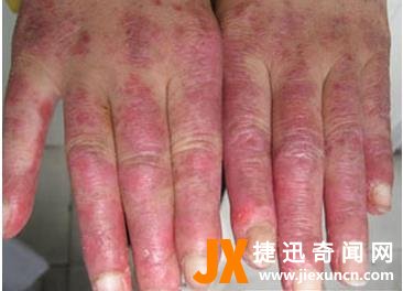 女性红斑狼疮早期症状：红斑狼疮最初症状图片