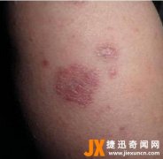 红斑狼疮是什么病  红斑狼疮图片