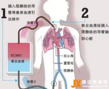ecmo费用多少钱一天（E